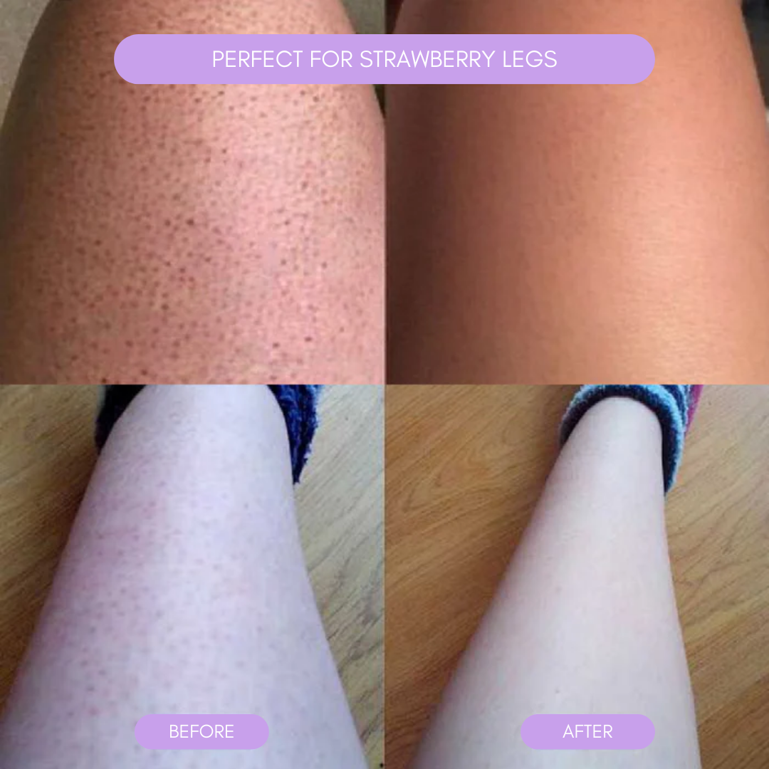 Hair removal device for smooth soft skin