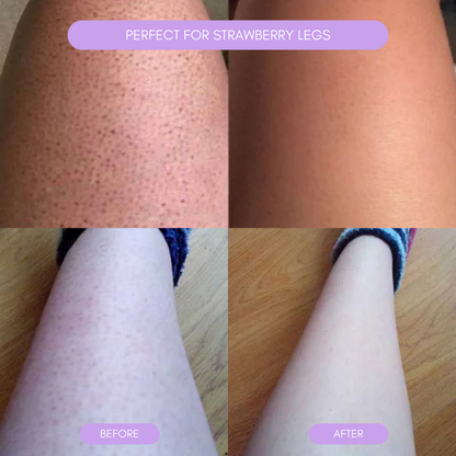 Hair removal device for smooth soft skin