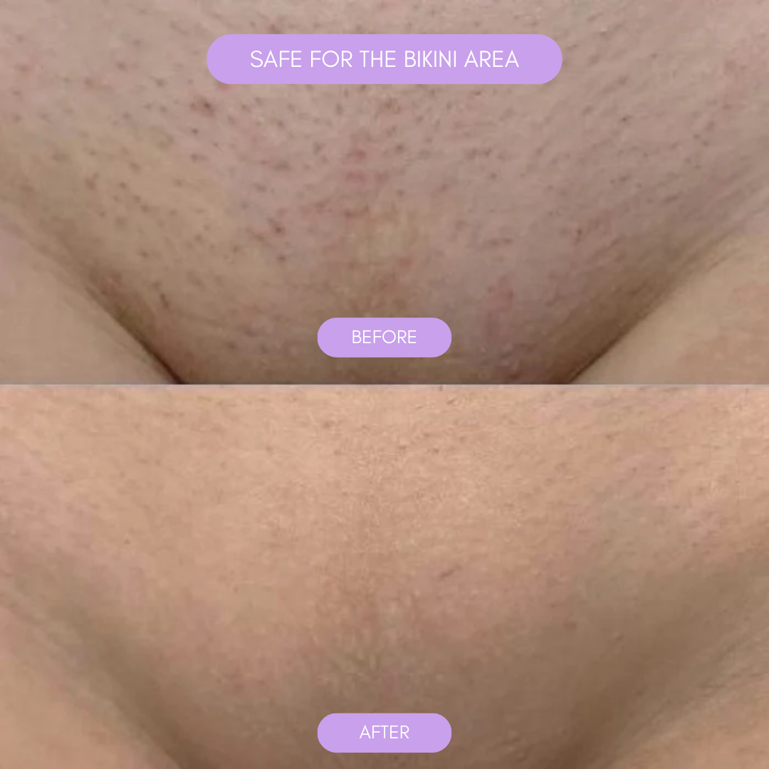 Hair removal device for smooth soft skin