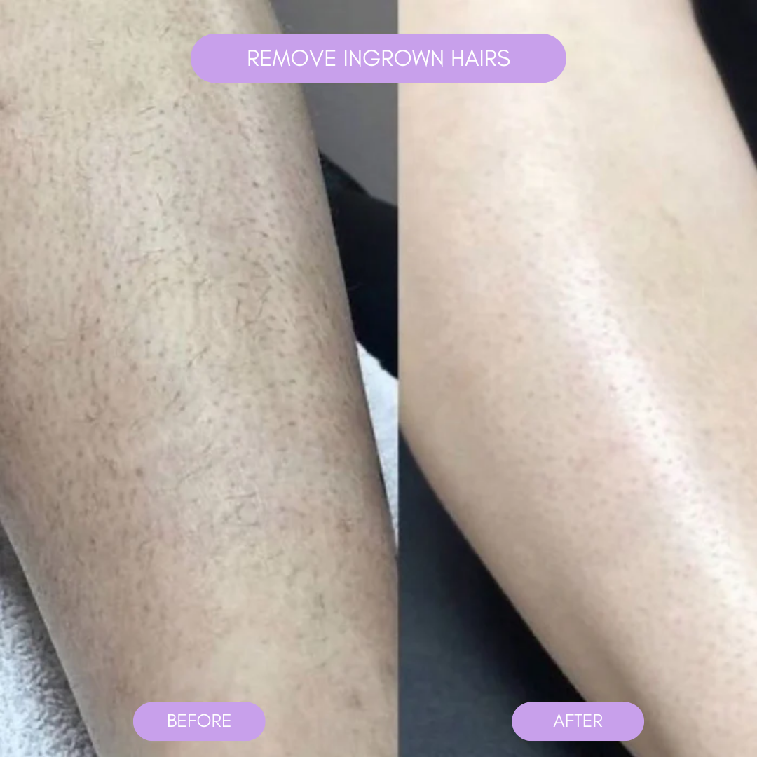 Hair removal device for smooth soft skin