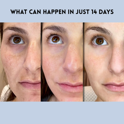 YouthLift™ Renew Strips – The Instant Solution for Timeless Beauty